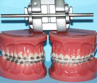 Selbstligierende Brackets