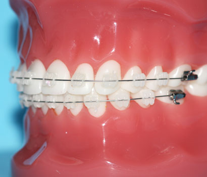 Ästhetische Brackets