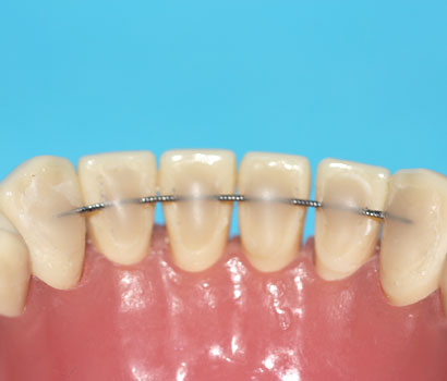 Festsitzender Retainer